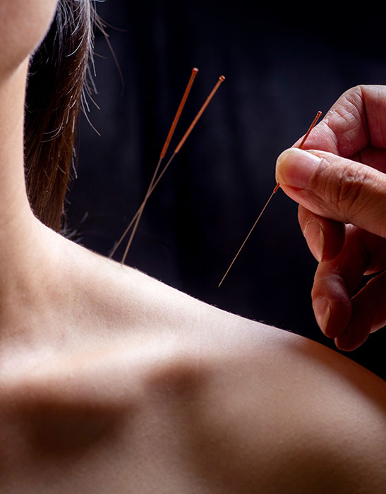 Doctor performing acupuncture