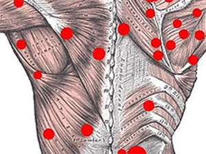 Graphic showing trigger points on back with red spots